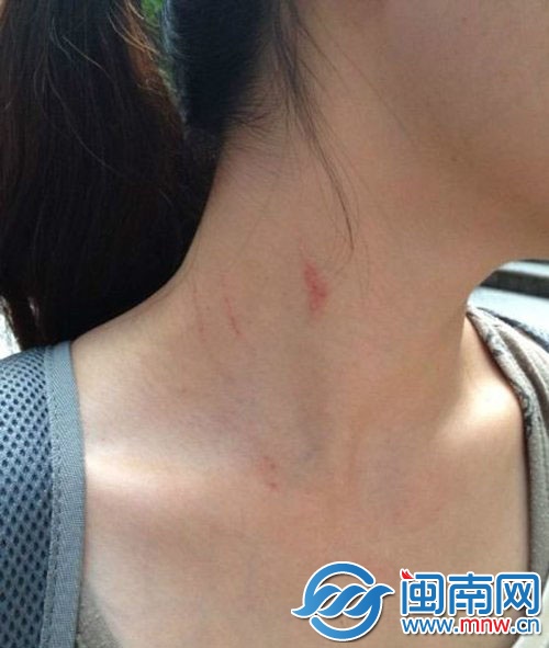 李女士脖子被抓伤