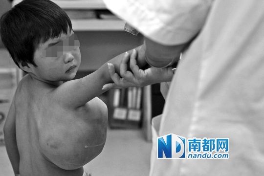 三岁半的小恩熙腋下长有血管瘤，正在医院接受治疗。 