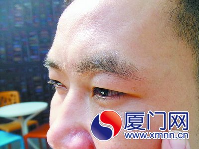 梁先生认为，打针后，他眼睛下的皱纹并未减少。