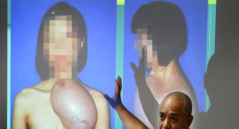 福建毁容少女将换脸