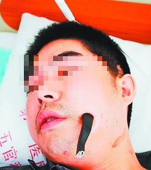 7厘米长车把戳入脸部