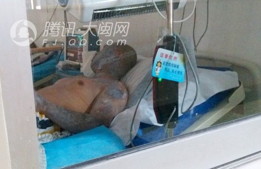 烧伤者