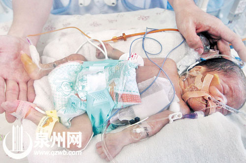 手术成功的“先心病宝宝”，在医护人员手中显得非常 