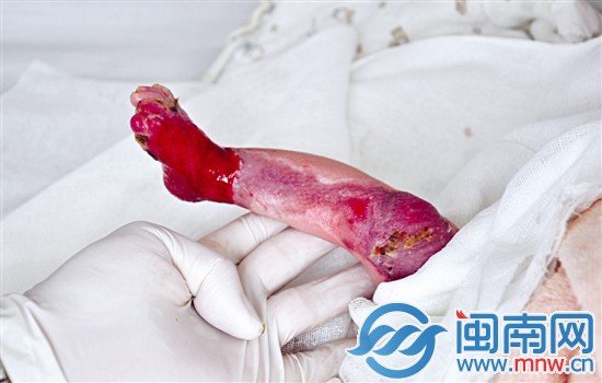 先天性皮肤缺失