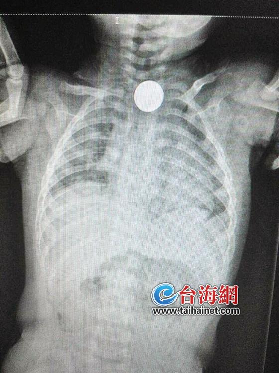 一龄童误吞硬币险丧命 卡在气管和食道交界处