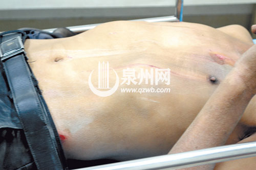 男子胸部被剐伤