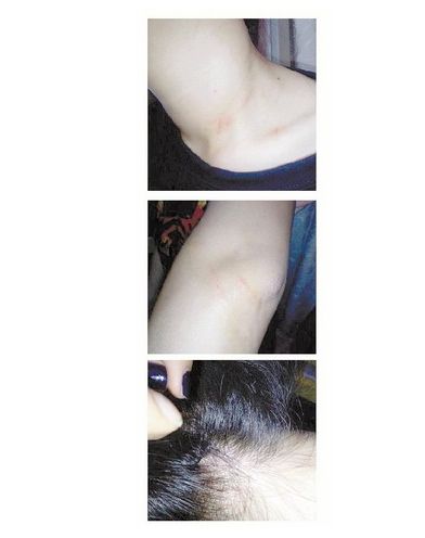 网友微博晒被“女疯子”抓伤的部位
