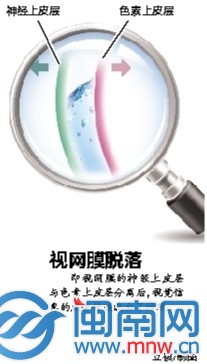 视网膜脱落