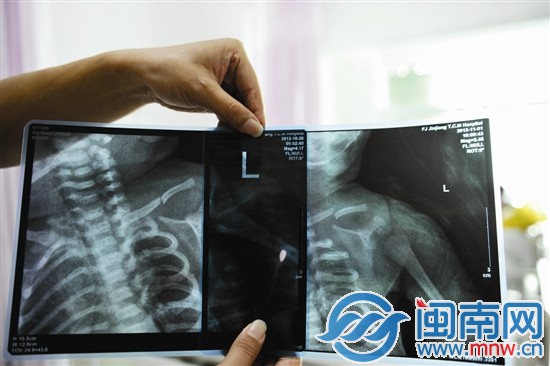 男婴X光片，可以看到他左锁骨中段骨折