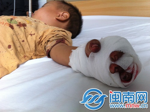 小园的左手无名指被三轮电动车链条绞断