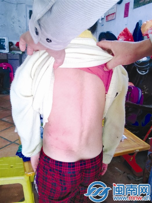 目前，被打女孩的后背已基本看不到伤痕