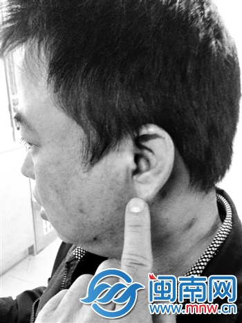 雷师傅经检查，为左耳膜开放性损伤
