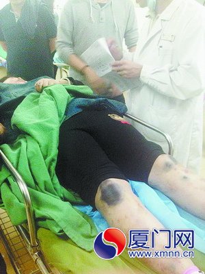 伤者郑女士全身多处严重淤青