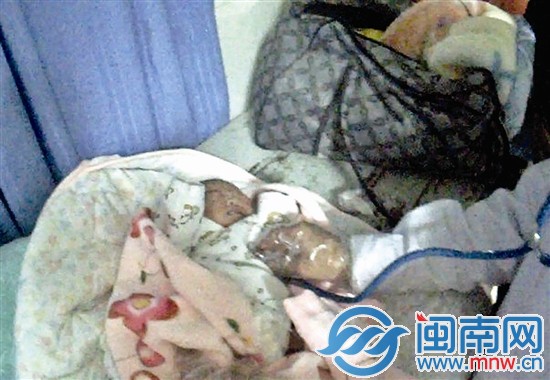 经漳州市医院确诊女婴下颚畸形