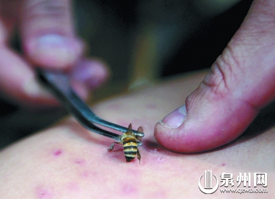 蜂毒有抗菌消炎、止痛消肿的药理功效