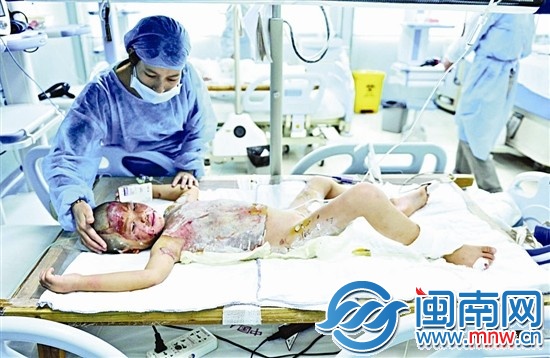 一个月前，小凡茹还在重症监护室治疗，上半身重度烫伤