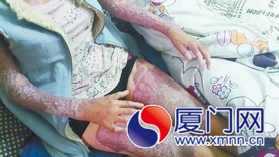 被烧伤后惨不忍睹