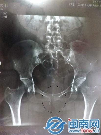 检查后，拍片显示，小傅下体有一根针形异物