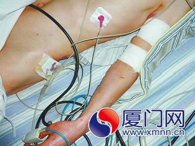 小刚被多处砍伤