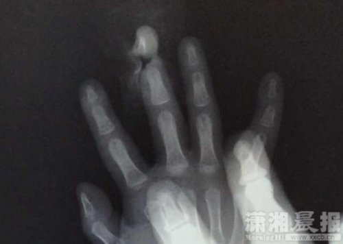 两岁幼童手指被切断