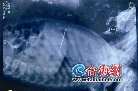 5厘米长缝衣针扎入小孩内脏 医生为难如何取针2