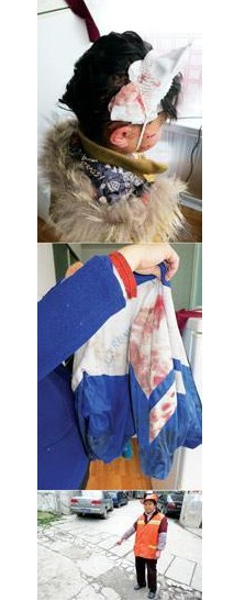 贵阳9岁女孩被五条恶犬撕咬
