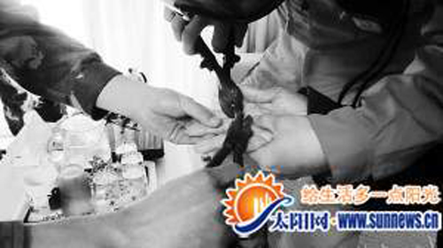 戒指卡手红肿化脓