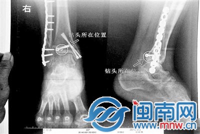 手术钻头留在骨头里了