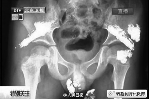 5岁男童被灌大量汞