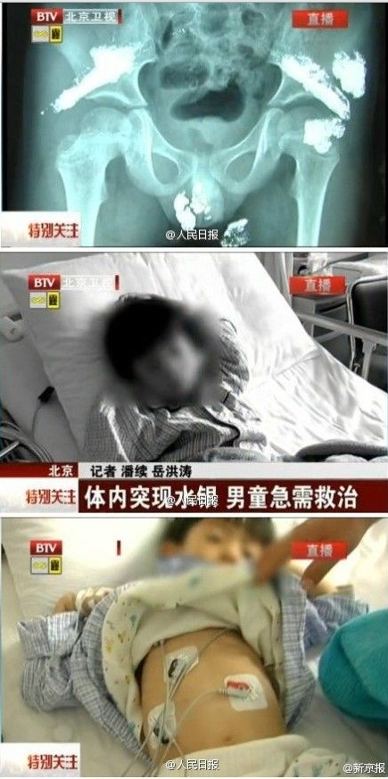5岁男童被灌大量汞1