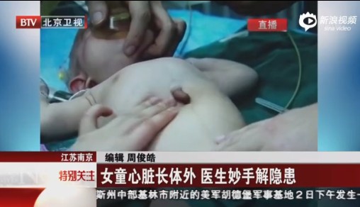 婴儿心脏裸露体外1
