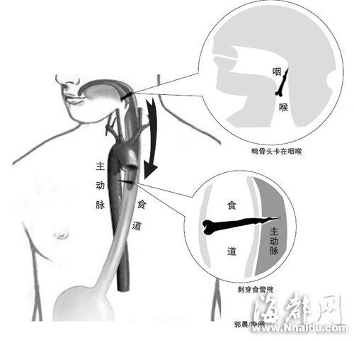 福州壮汉鸭骨头卡喉 硬吞刮破主动脉身亡