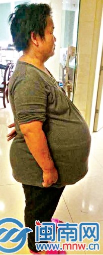 入院时，身高153cm的姚女士腹围达到158cm
