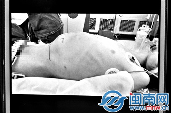11岁男孩 肚子长7斤恶性肿瘤