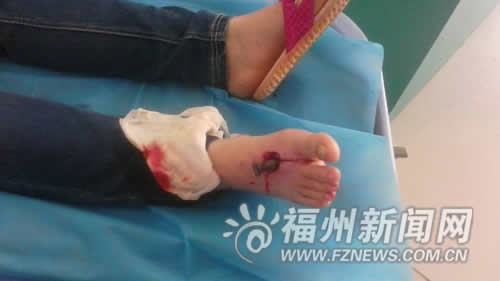 钢条穿透这名妇女的脚掌