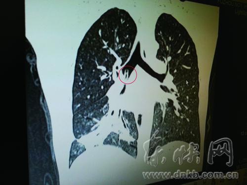 CT显示肺部有异物