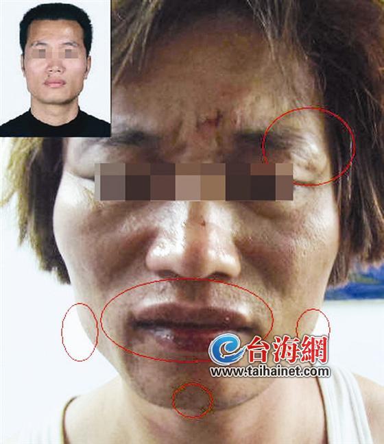 捅死人后“整容”逃亡20年