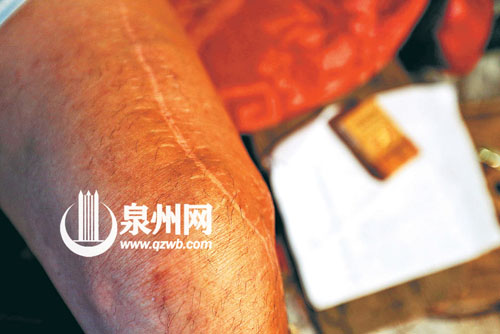 几年前出车祸腿断了，医疗用的钢板至今仍在腿内