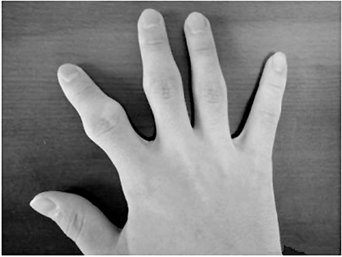 网上转发的因折手指引起关节变形的图片。