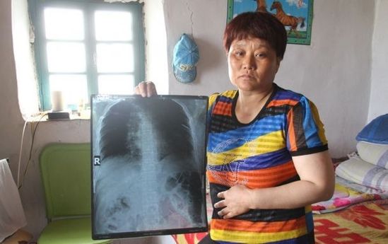 女子疑遭前夫家暴体内5根针扎入肝肾