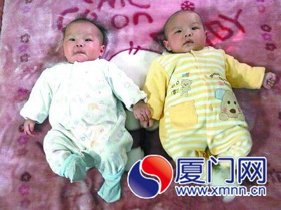 厦患巨结肠双胞胎女婴已恢复正常
