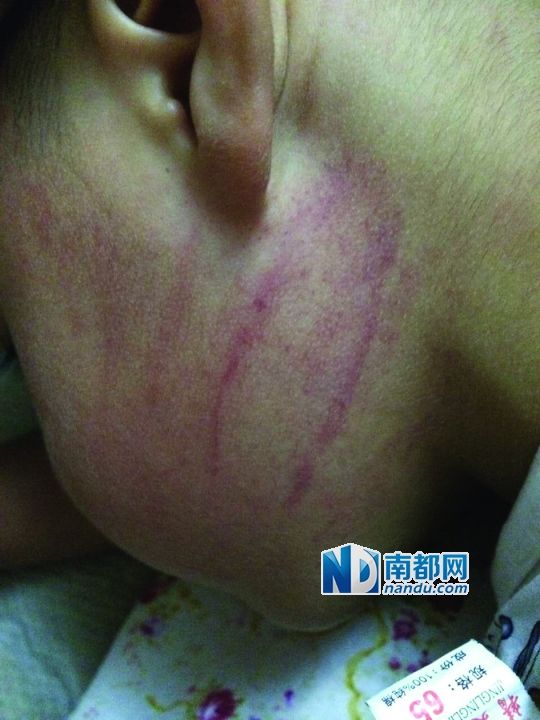 保姆因两岁男童不吃药掌掴致多条淤痕