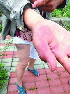 妇人阻止男子打狗,遭攻击,身上多处瘀血红肿。来源