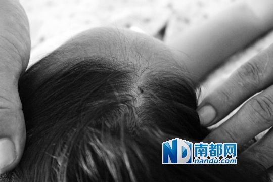 女童头上被扎的针孔（圆圈处）。