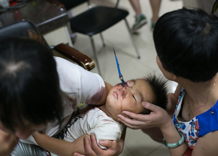 杭州3岁男童独自在家 将剪刀插入右眼3