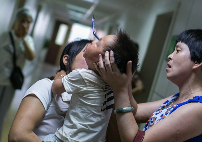 杭州3岁男童独自在家 将剪刀插入右眼2