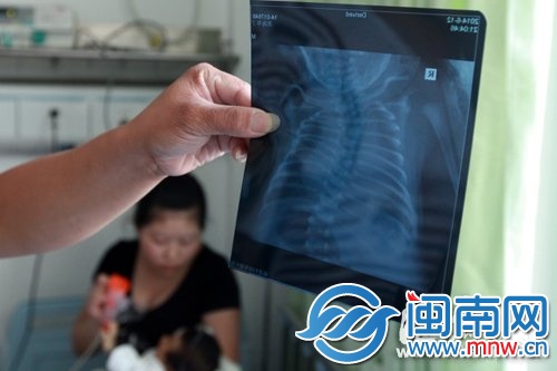 孩子刚满月，查出肋骨多三根，引发并发症